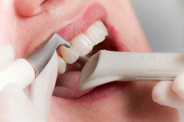 Преимущества ультразвуковой чистки зубов